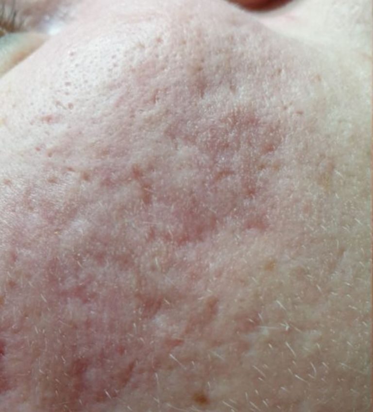 76