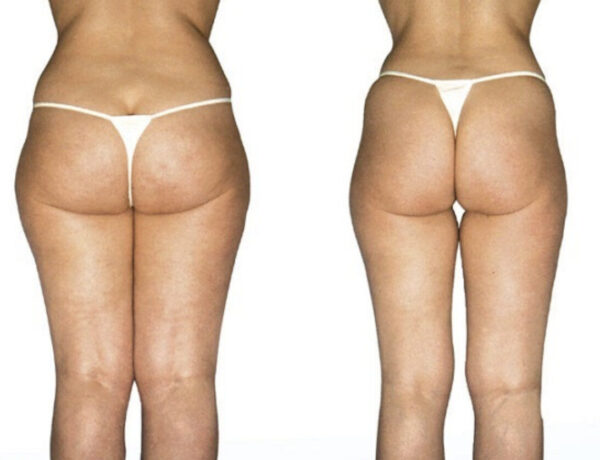 Endermologia LPG Alliance® - obrazek 2