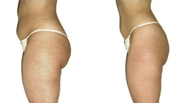 Endermologia LPG Alliance® - obrazek 3