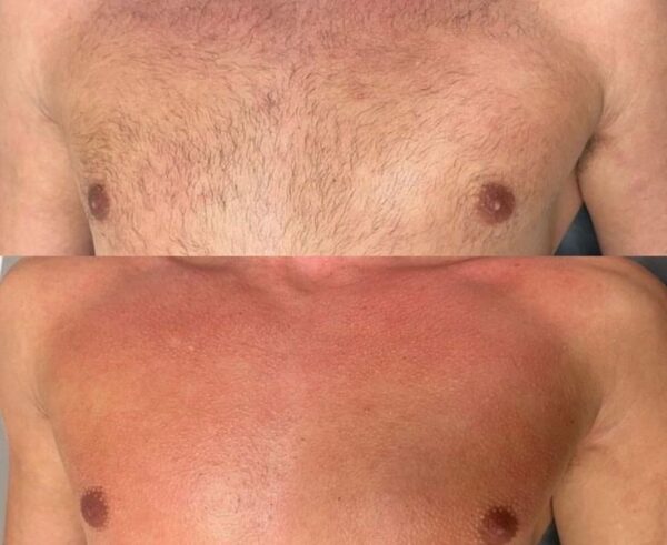 Depilacja laserowa klatka piersiowa - pakiet 6 zabiegów - obrazek 3